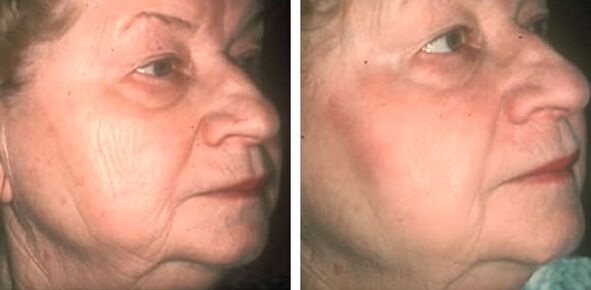 antes e depois do rejuvenescimento da pele a laser foto 4