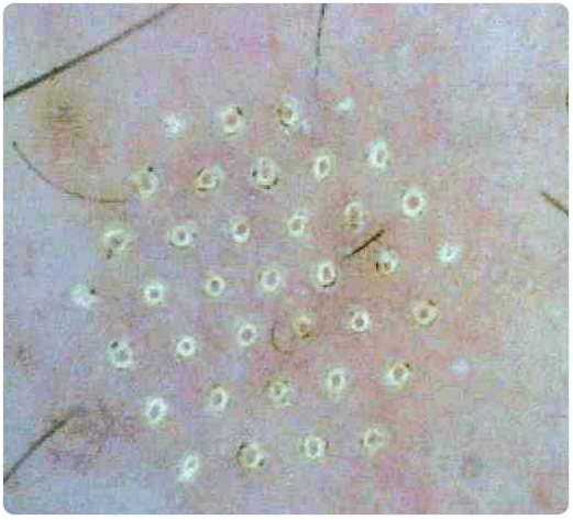 pele sob um microscópio após rejuvenescimento fracionado