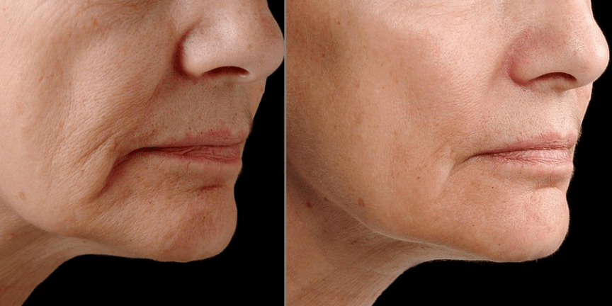 Rejuvenescimento fracionário a laser - efeito