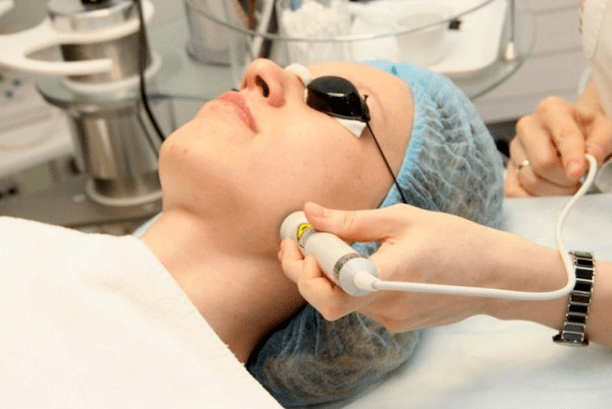 Biorevitalização a laser