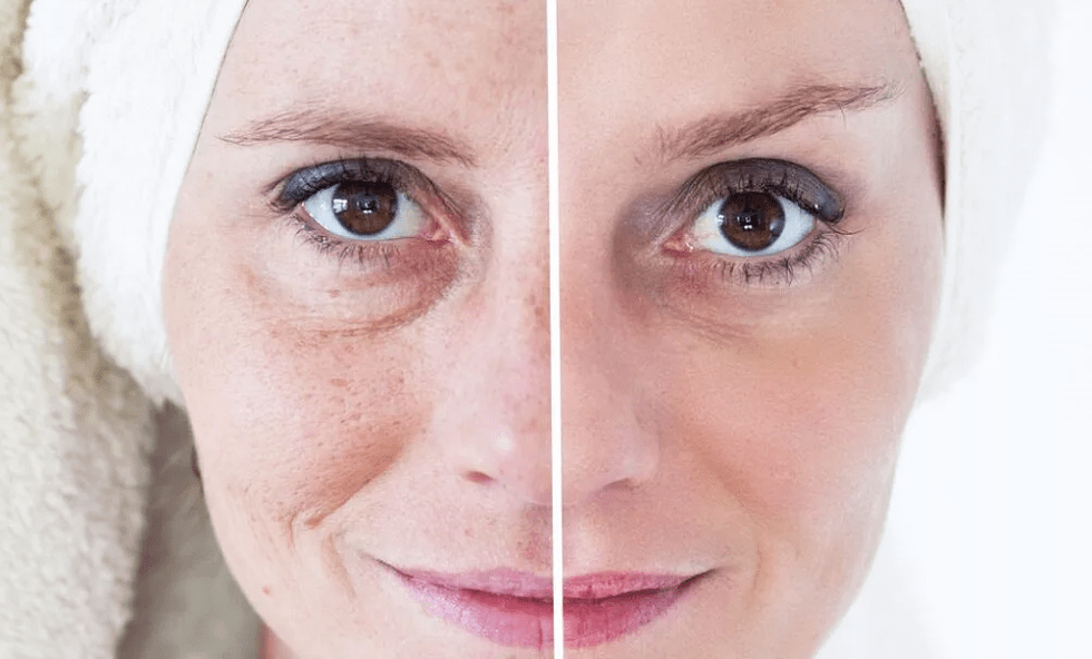 rejuvenescimento facial a laser