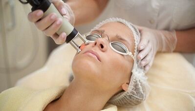 tipos de rejuvenescimento fracionado da pele facial